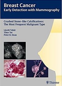 Breast Cancer: Early Detection with Mammography: Crushed Stone-like Calcifications: The Most Frequent Malignant Type, 1e (Original Publisher PDF)