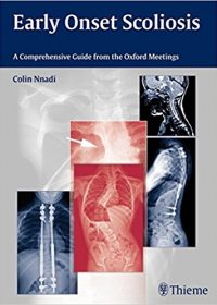 Early Onset Scoliosis: A Comprehensive Guide from the Oxford Meetings, 1e (Original Publisher PDF)