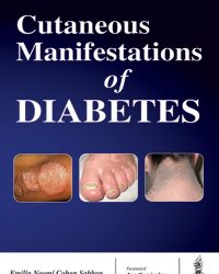 Cutaneous Manifestations of Diabetes, 1e (True PDF)