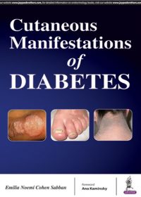 Cutaneous Manifestations of Diabetes, 1e (True PDF)