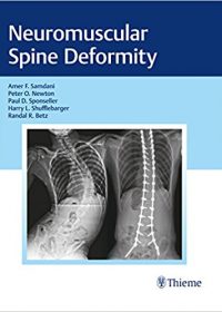 Neuromuscular Spine Deformity, 1e (Original Publisher PDF)