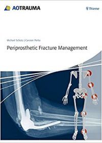 Periprosthetic Fracture Management, 1E (Original Publisher PDF)