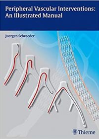 Peripheral Vascular Interventions: An Illustrated Manual, 1e (Original Publisher PDF)