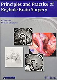 Principles and Practice of Keyhole Brain Surgery, 1e (Original Publisher PDF)