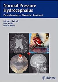 NPH - Normal Pressure Hydrocephalus: Pathophysiology - Diagnosis - Treatment, 1e (Original Publisher PDF)